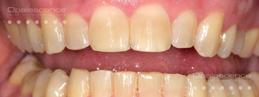Opalescence diş beyazlatma sistemi öncesi