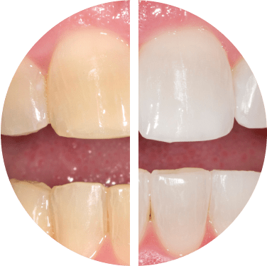 Before/After using Opalescence™ PF